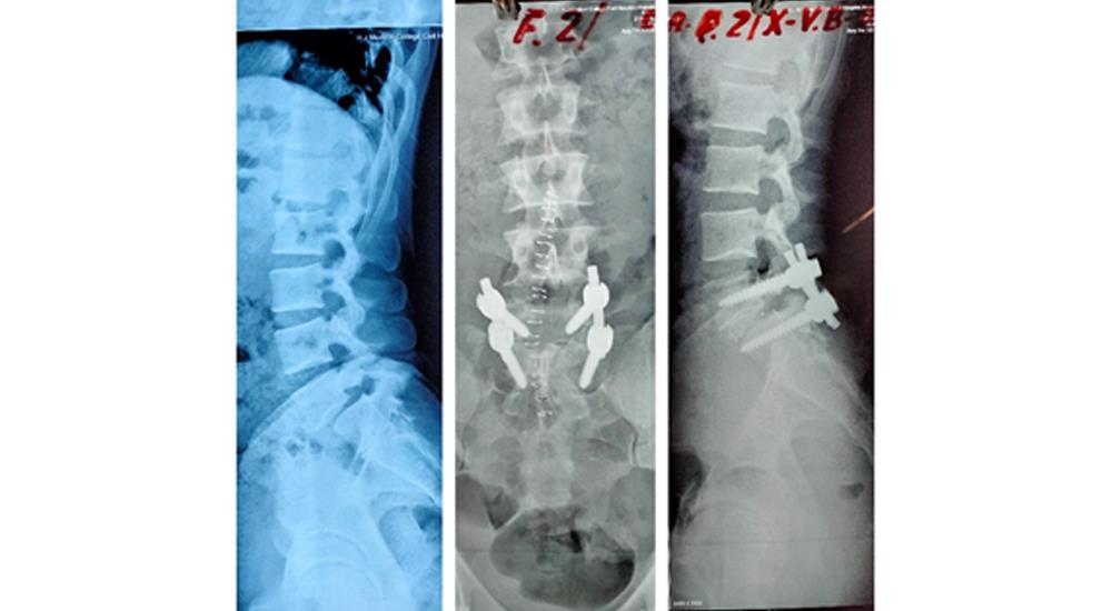 Spine Surgery