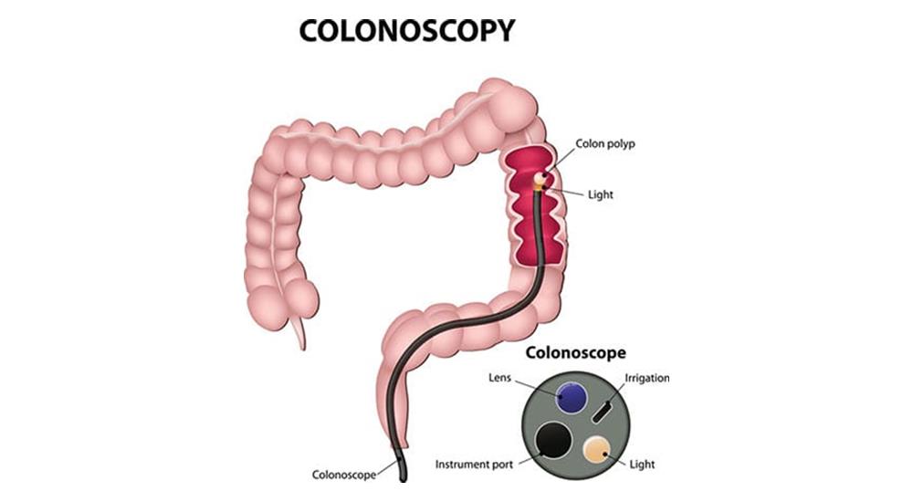 Colonoscopy