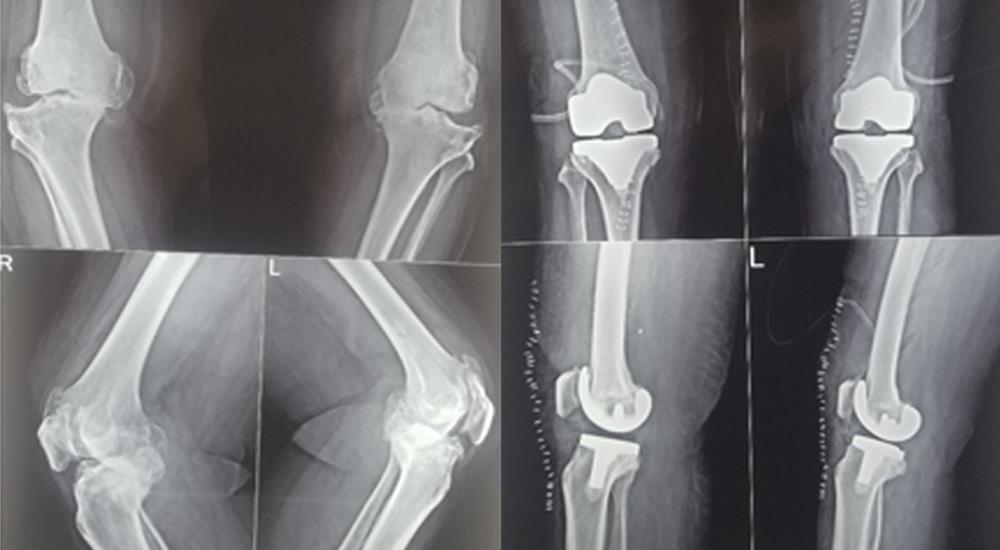 Joint Replacement