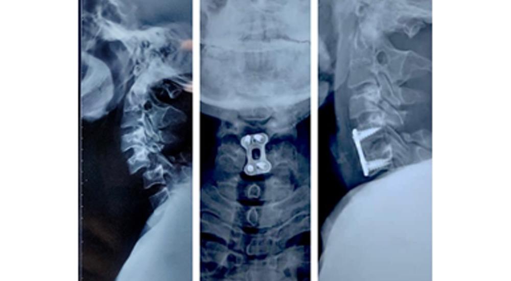 Spine Surgery