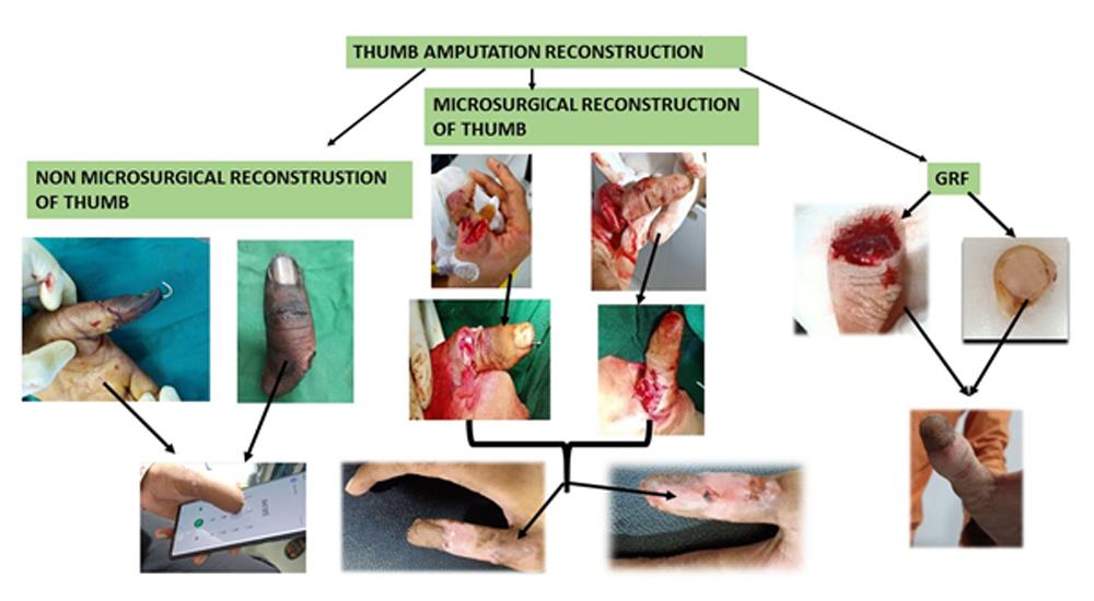 Hand Injuries