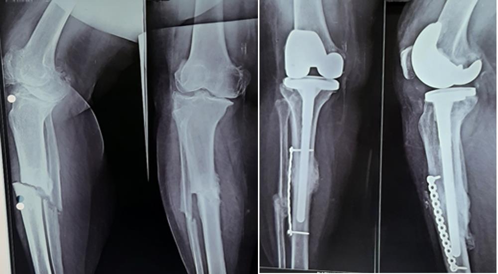 Joint Replacement