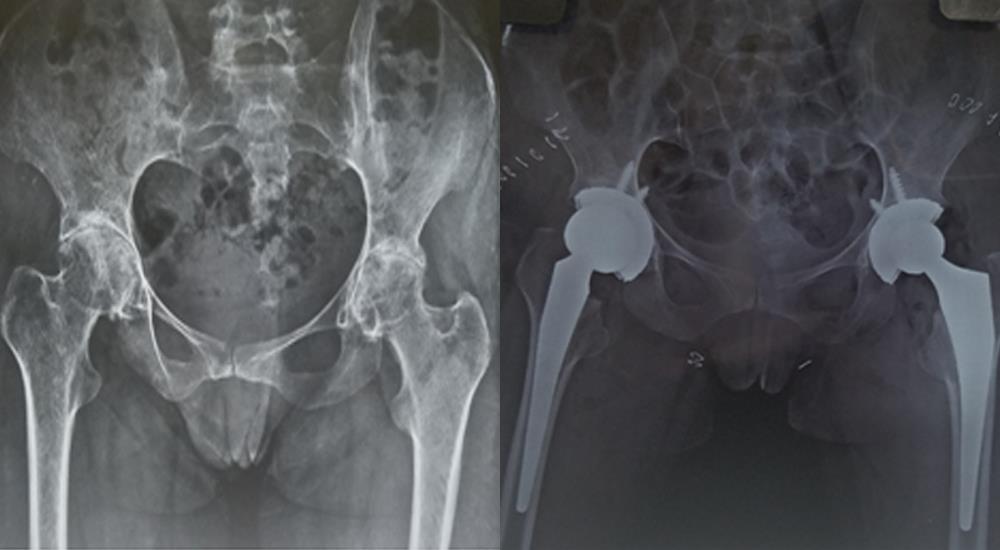 Joint Replacement 