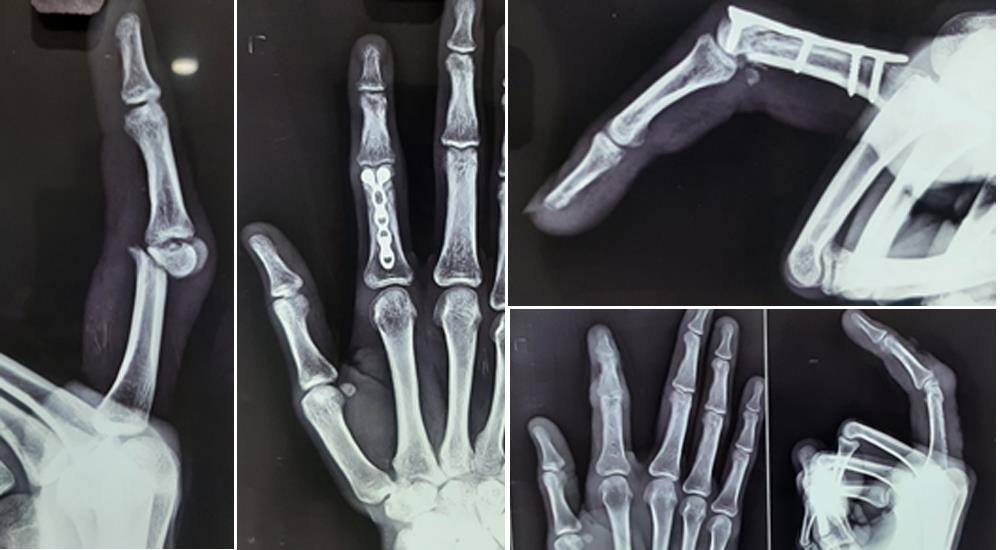 Hand Injuries