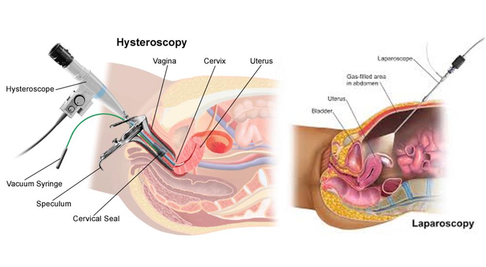 Hysterectomy Vaginal And Laparoscopic