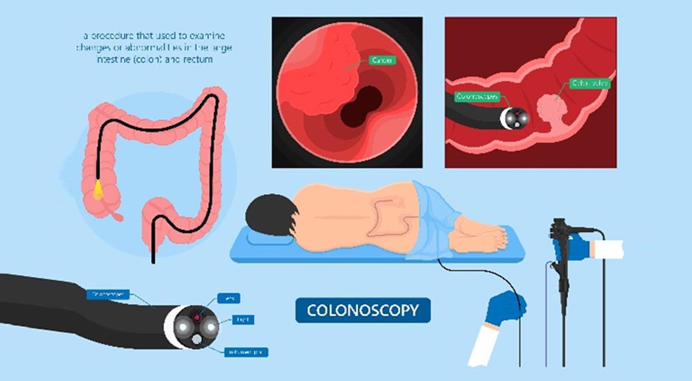 Colonoscopy